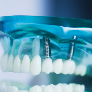 Full Mouth Restoration Full Mouth Restoration