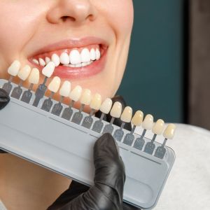 dental-veneers-colombia dental veneers colombia